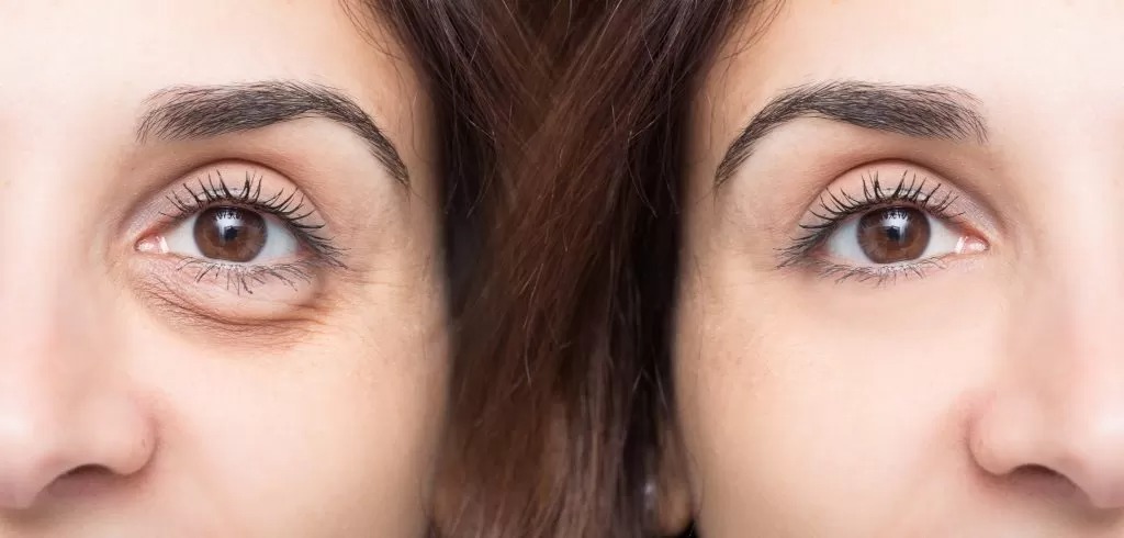 How to bags under eyes treatment?